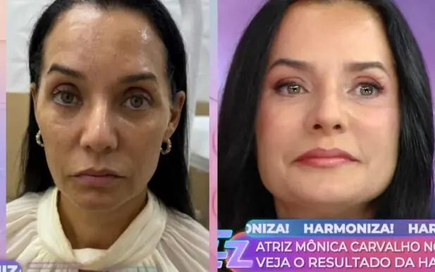 Mônica Carvalho exibe harmonização facial ao vivo na TV