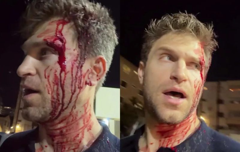 Ator de Pretty Little Liars é assaltado e agredido em LA