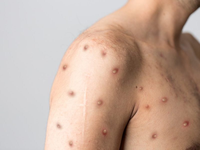 Rio de Janeiro registra 74 casos de Mpox em dois meses