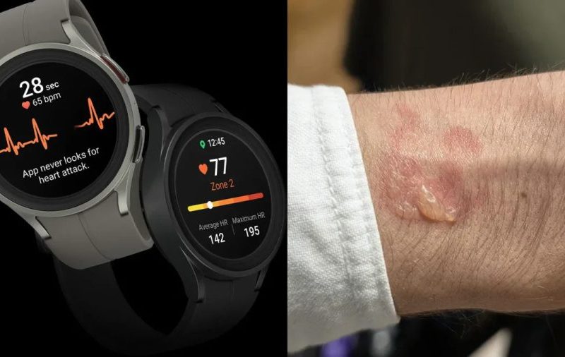 Galaxy Watch: Usuários relatam queimaduras e bolhas ao dormir