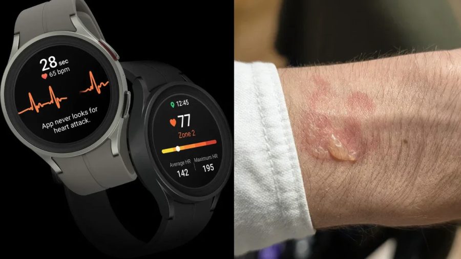 Usuários relatam queimaduras e irritação na pele após usar Galaxy Watch durante a noite